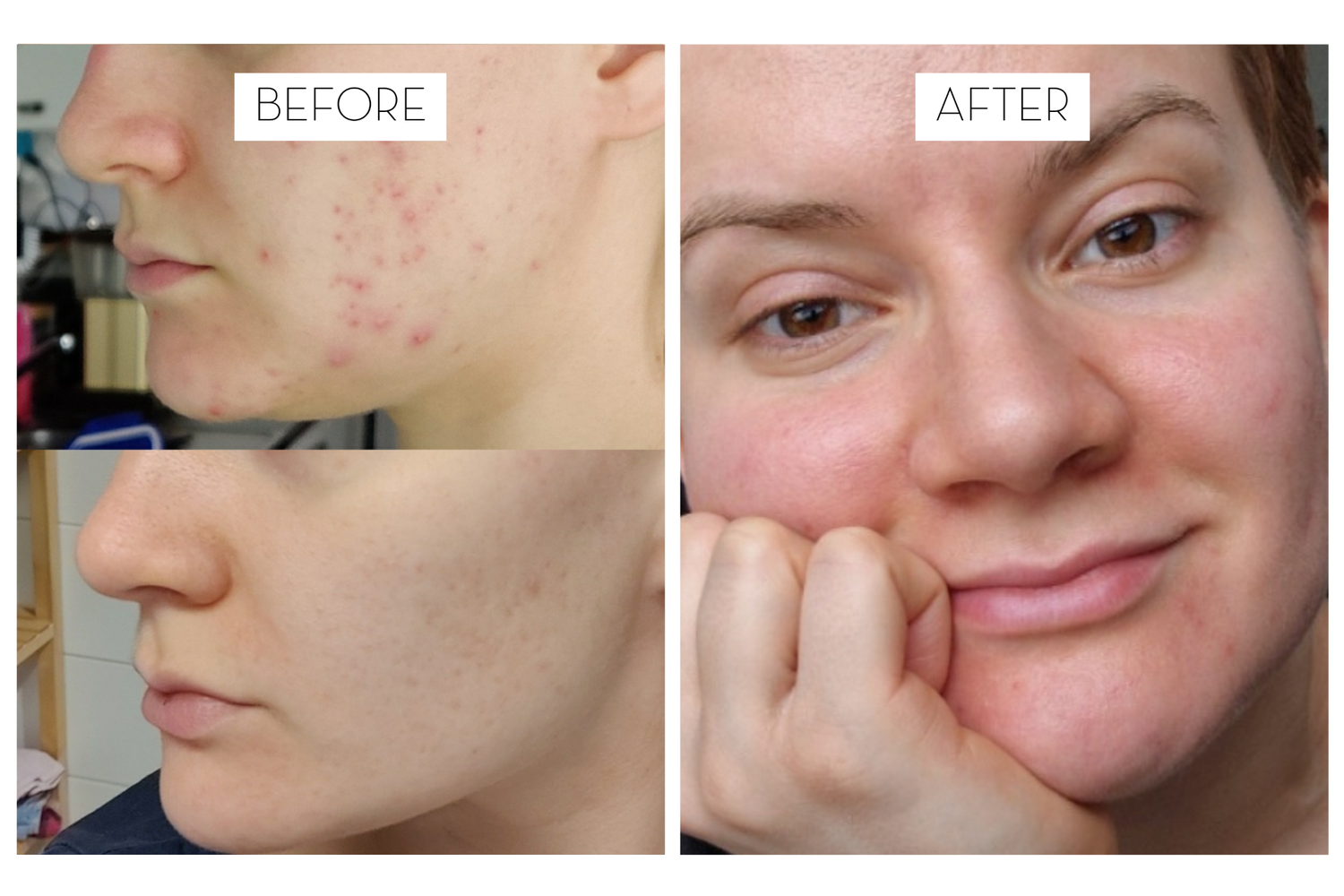 Iida's update on adult acne and 3 years of Laponie