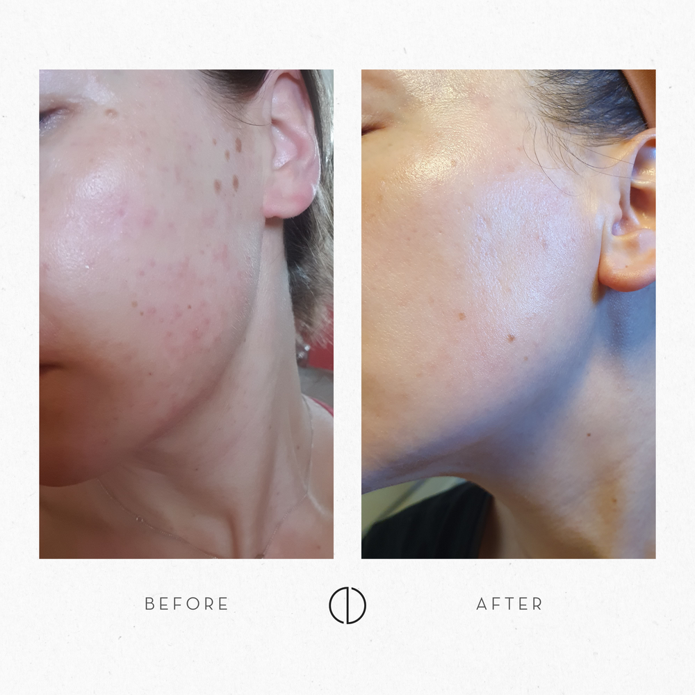 Anna: Sensitised & irritated skin