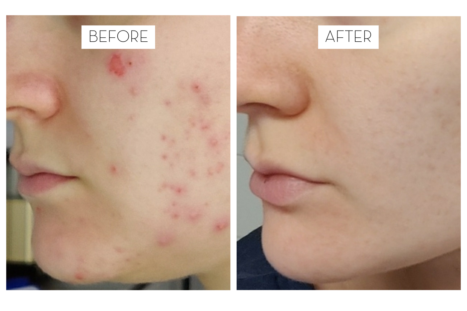 Laponie user stories: Iida & Adult acne