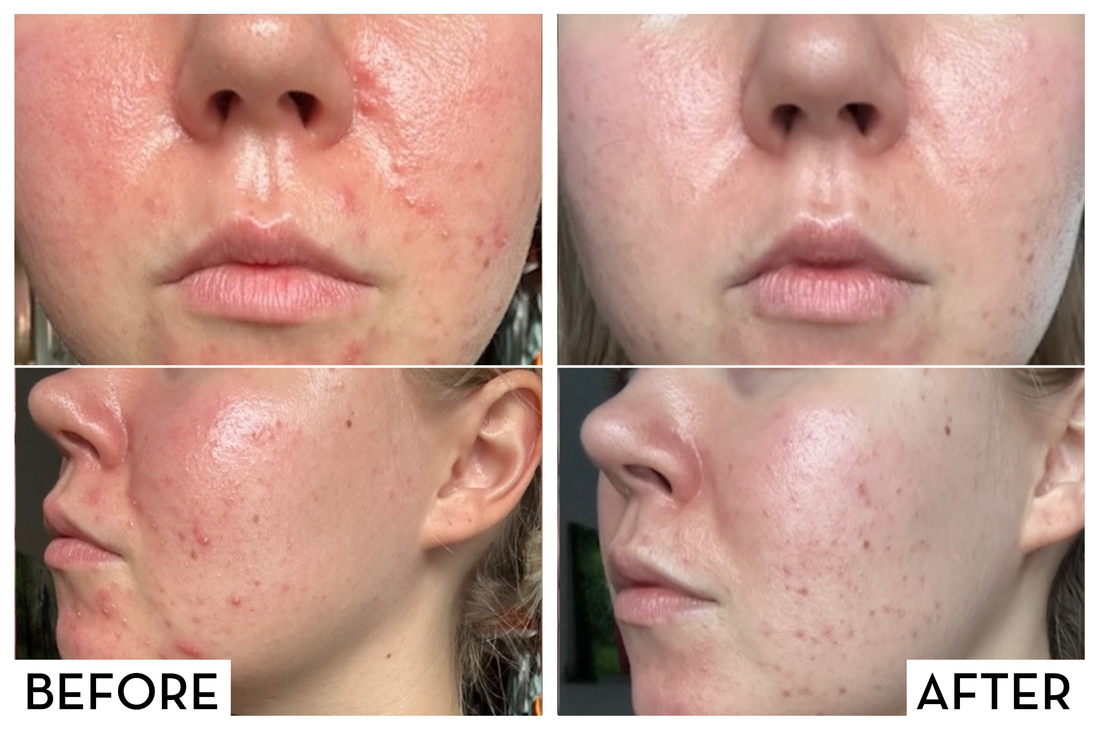 Elsa & problem skin with POD, hormonal acne & rosacea