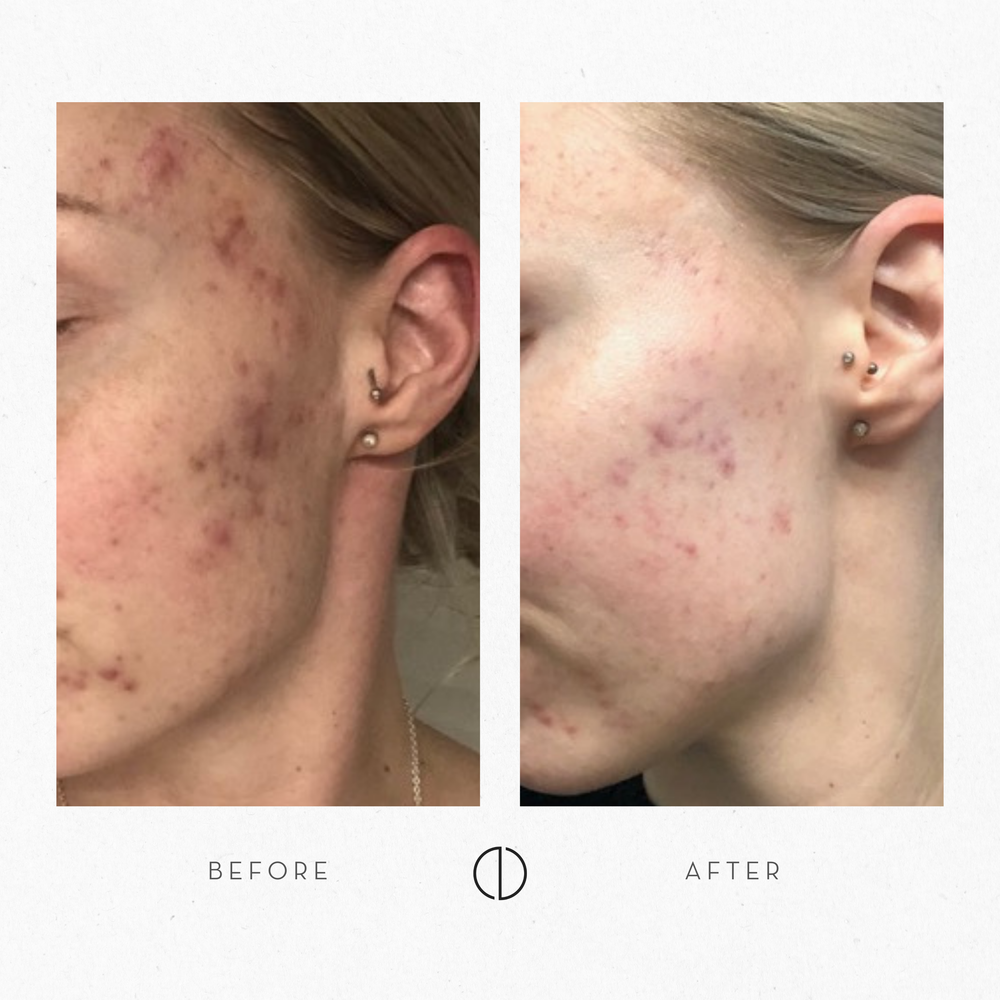 Hanna: Acne