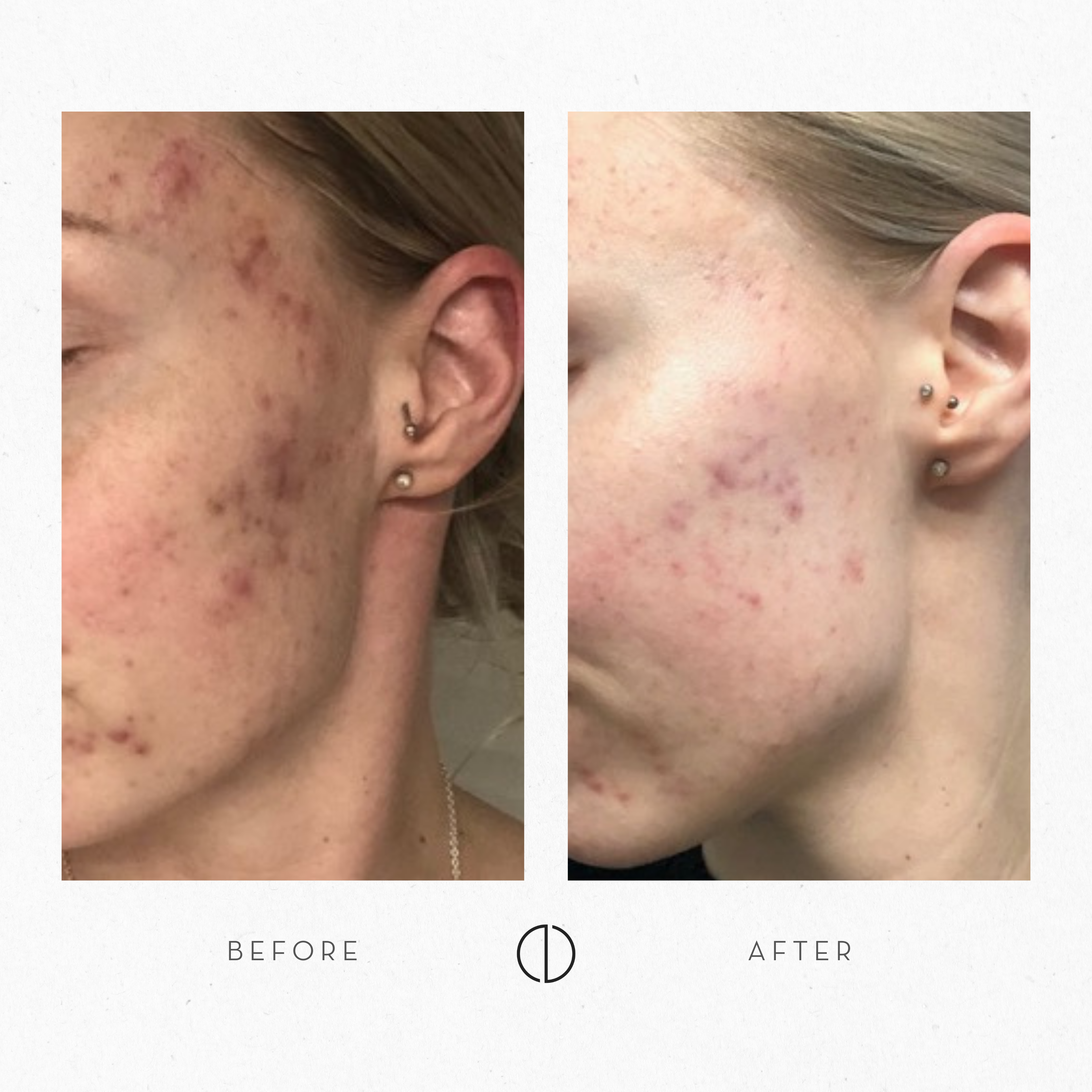 Hanna: Acne
