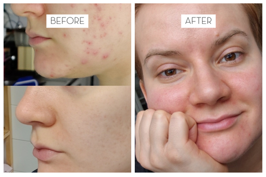 Iida's update on adult acne and 3 years of Laponie