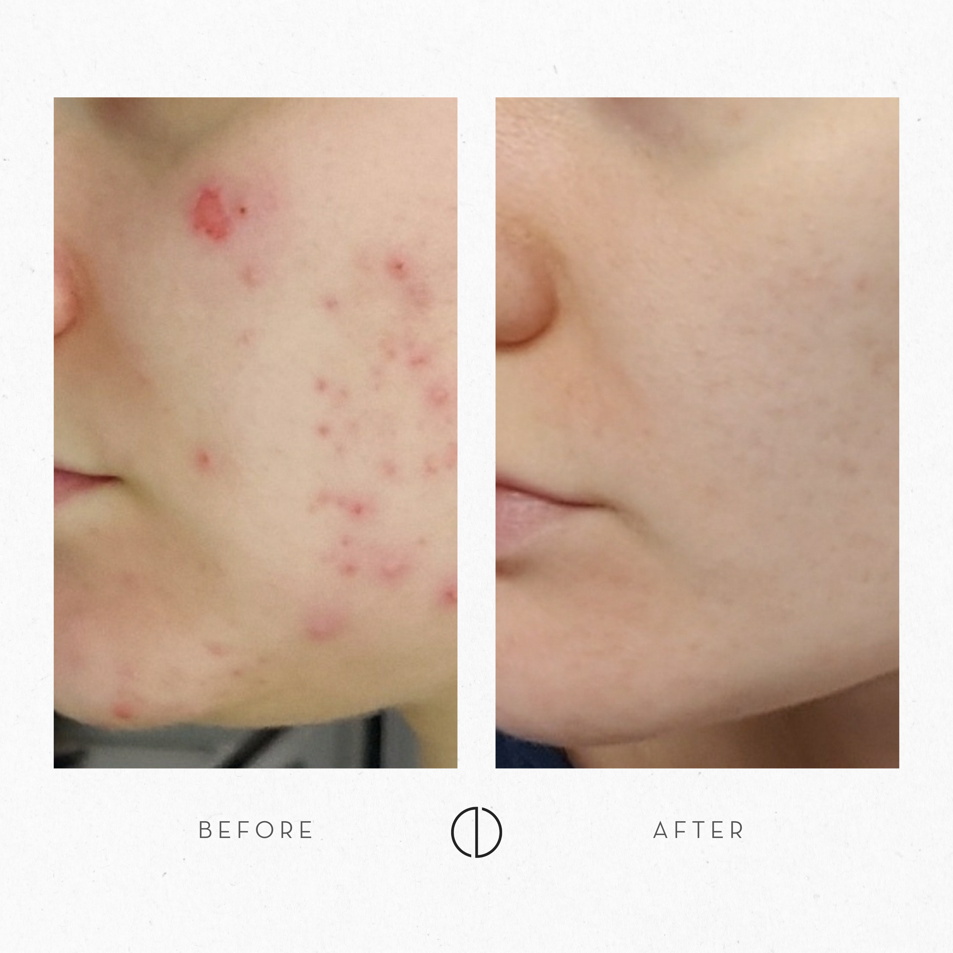 Iida: Adult acne