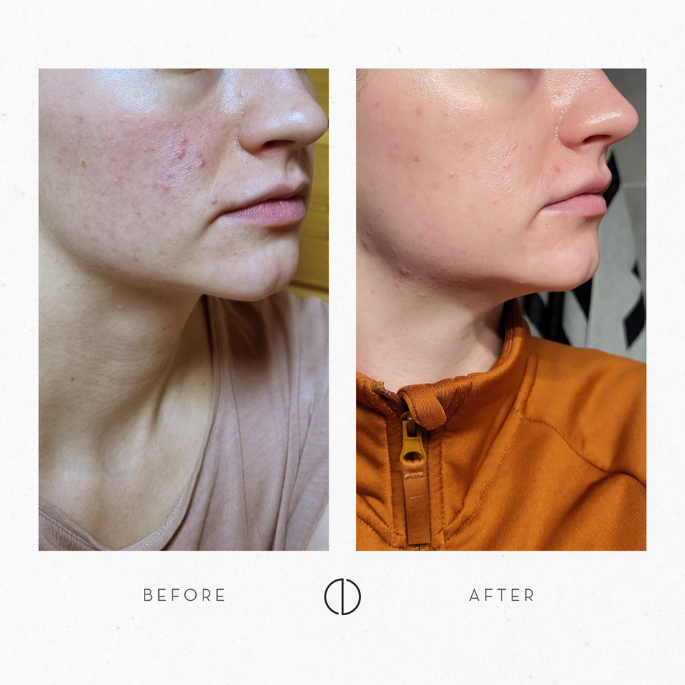 Jenna: POD, seborrhea and rosacea