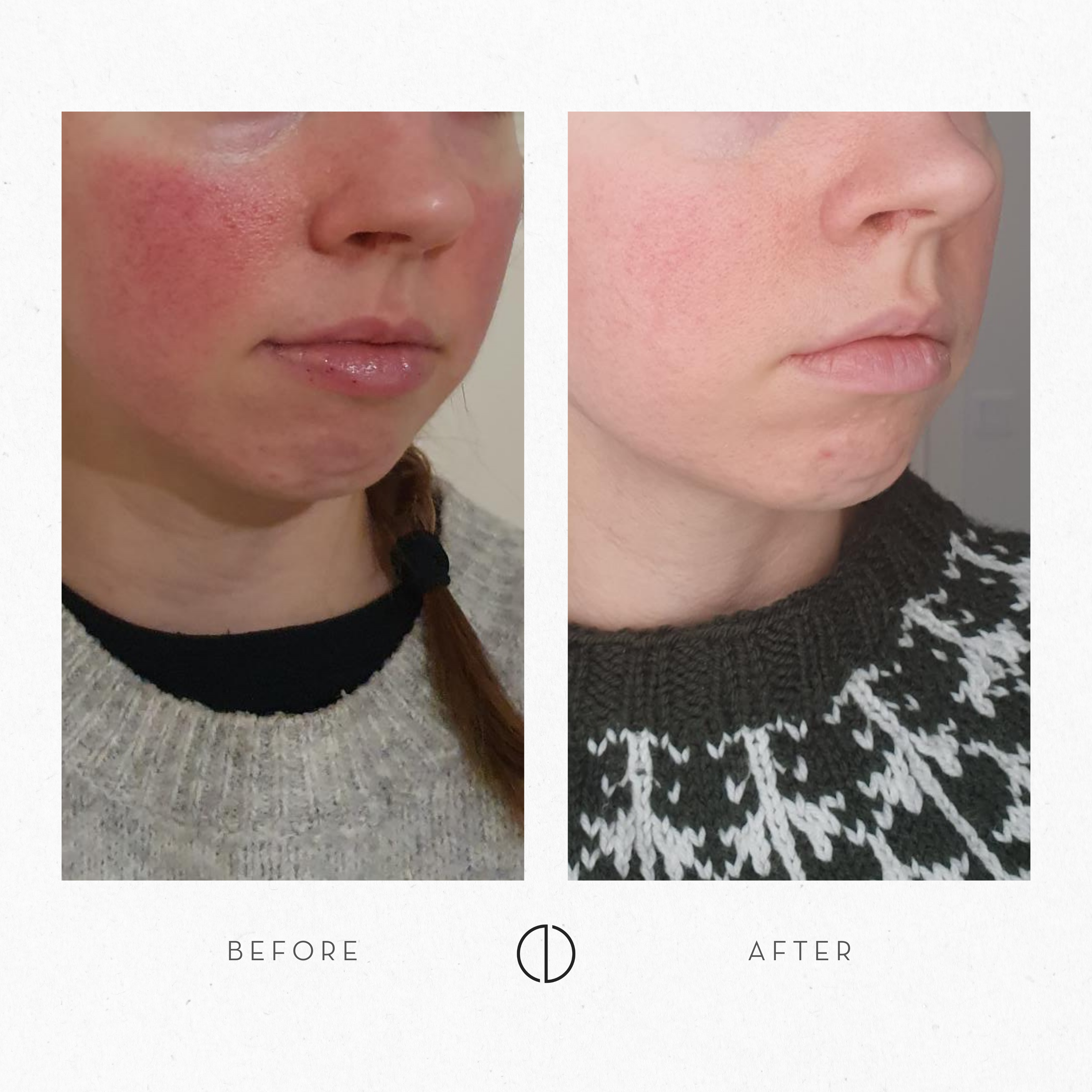 Krista & Rosacea