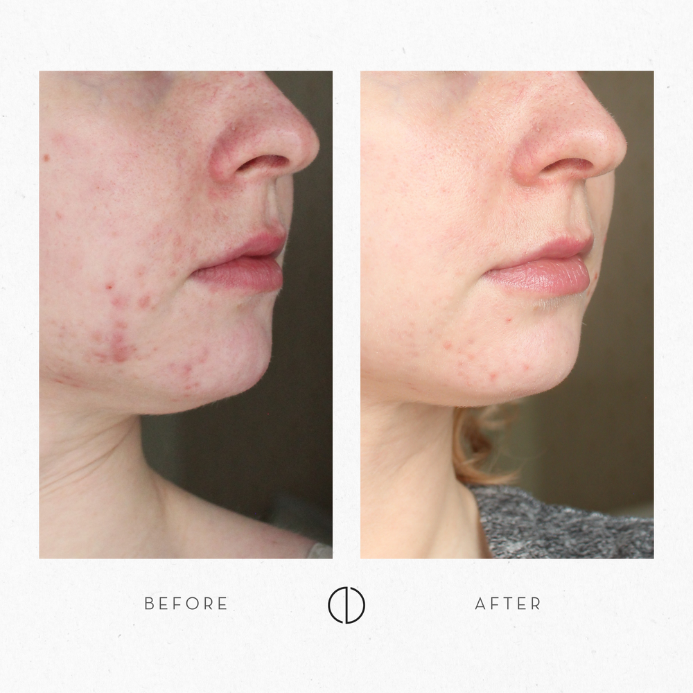 Milja: Sensitive & breakout-prone skin