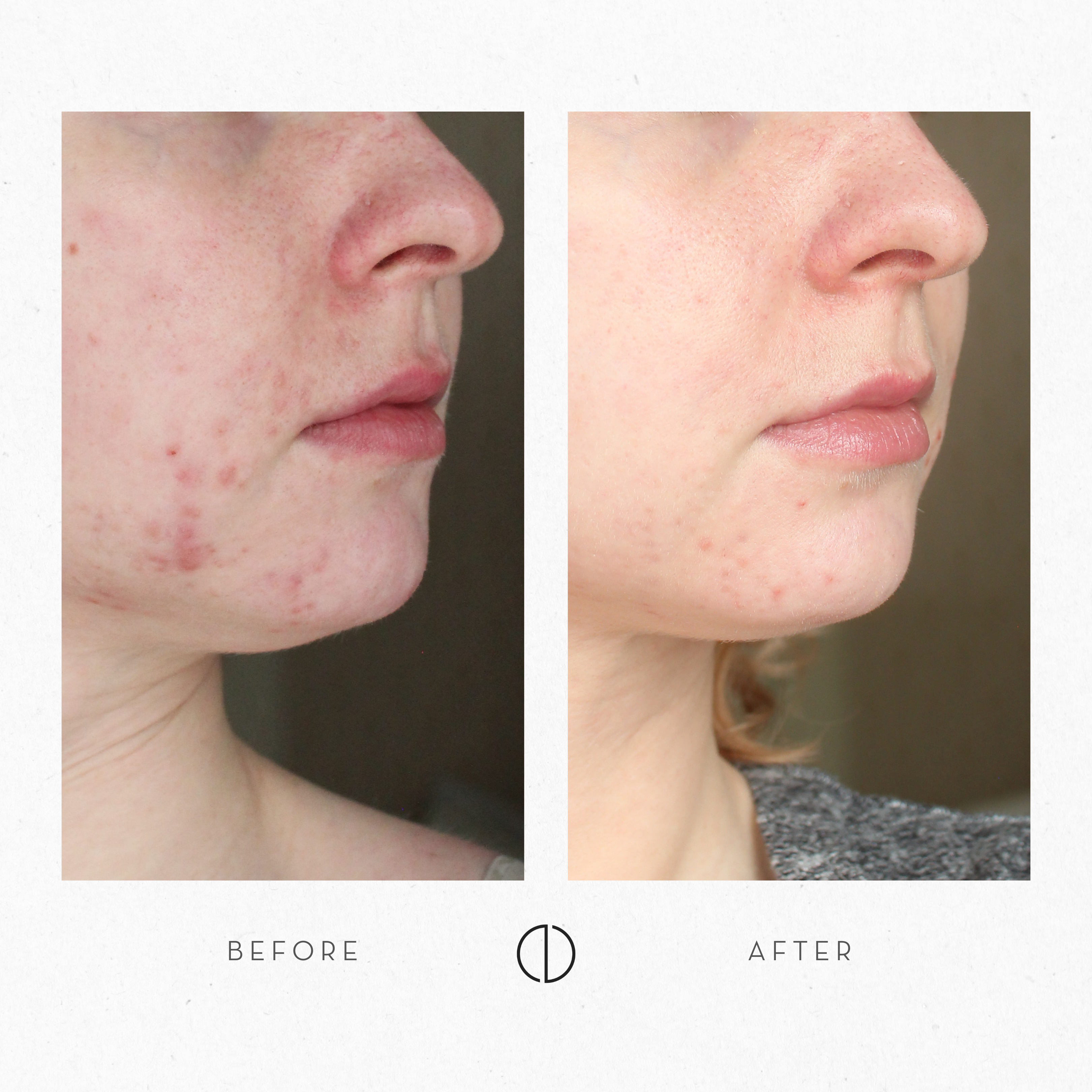 Milja: Sensitive & breakout-prone skin