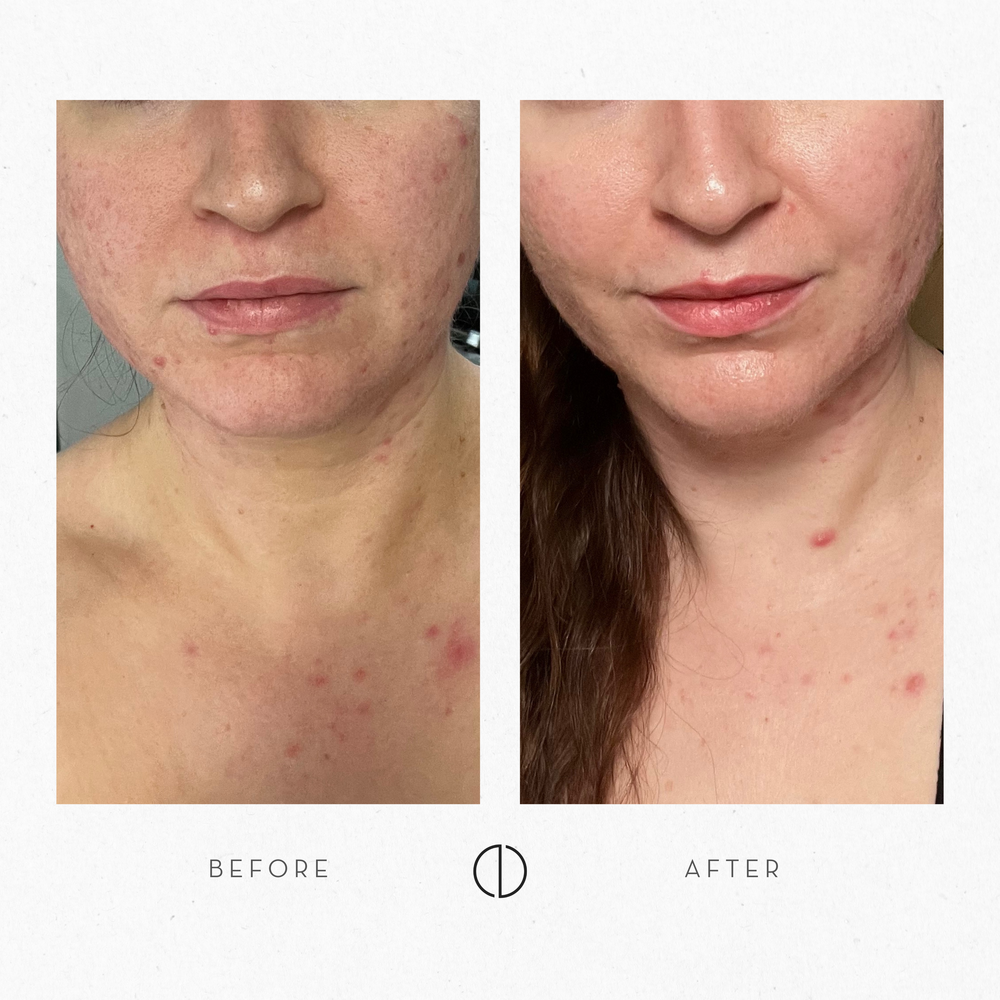 Netta: Acne