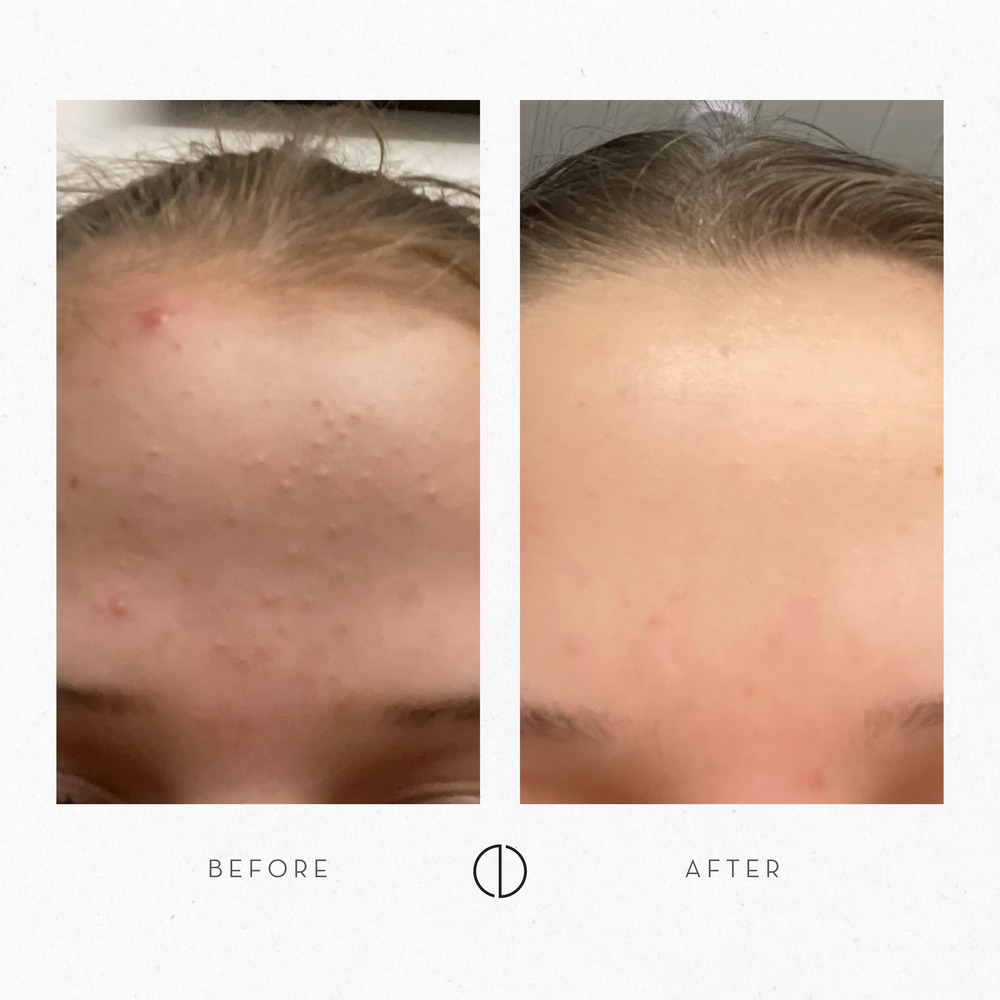 Sointu: Dry, sensitive skin with congestion