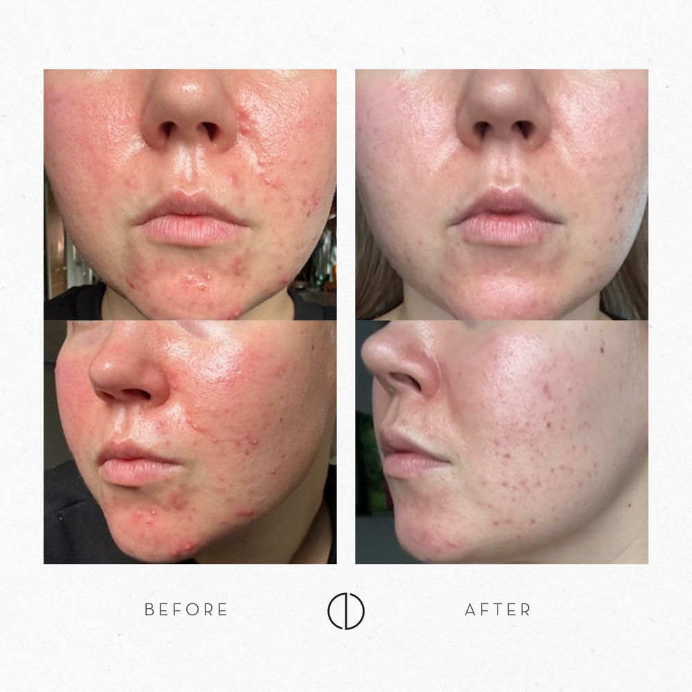 Elsa: POD, hormonal acne & rosacea