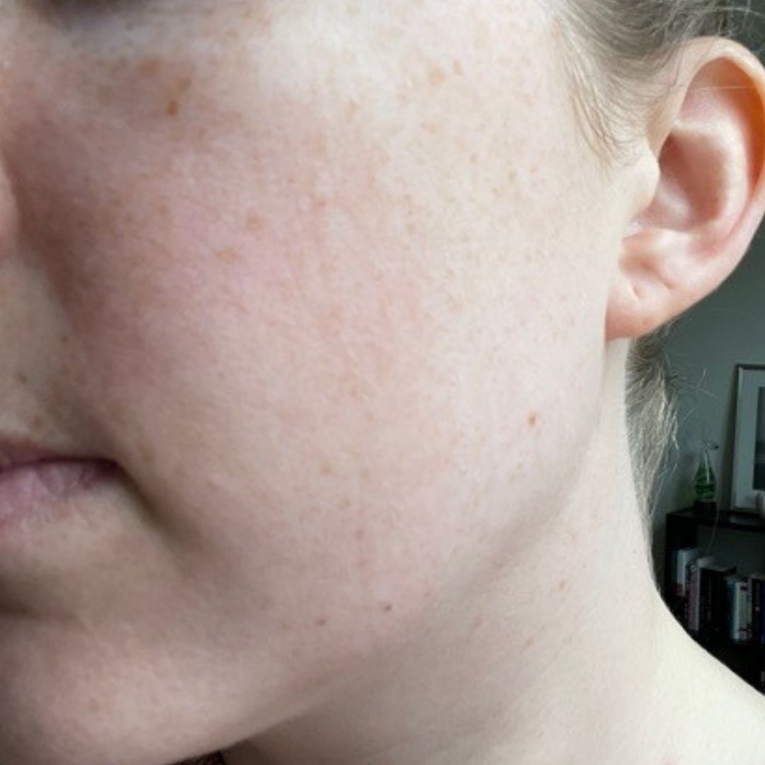Emily: Very dry skin