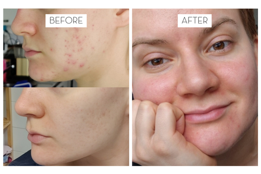 Iida's update on adult acne and 3 years of Laponie