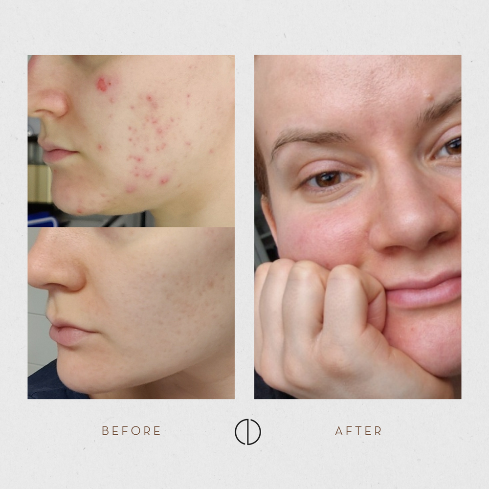 Iida's update: Adult acne & 5 years of Laponie