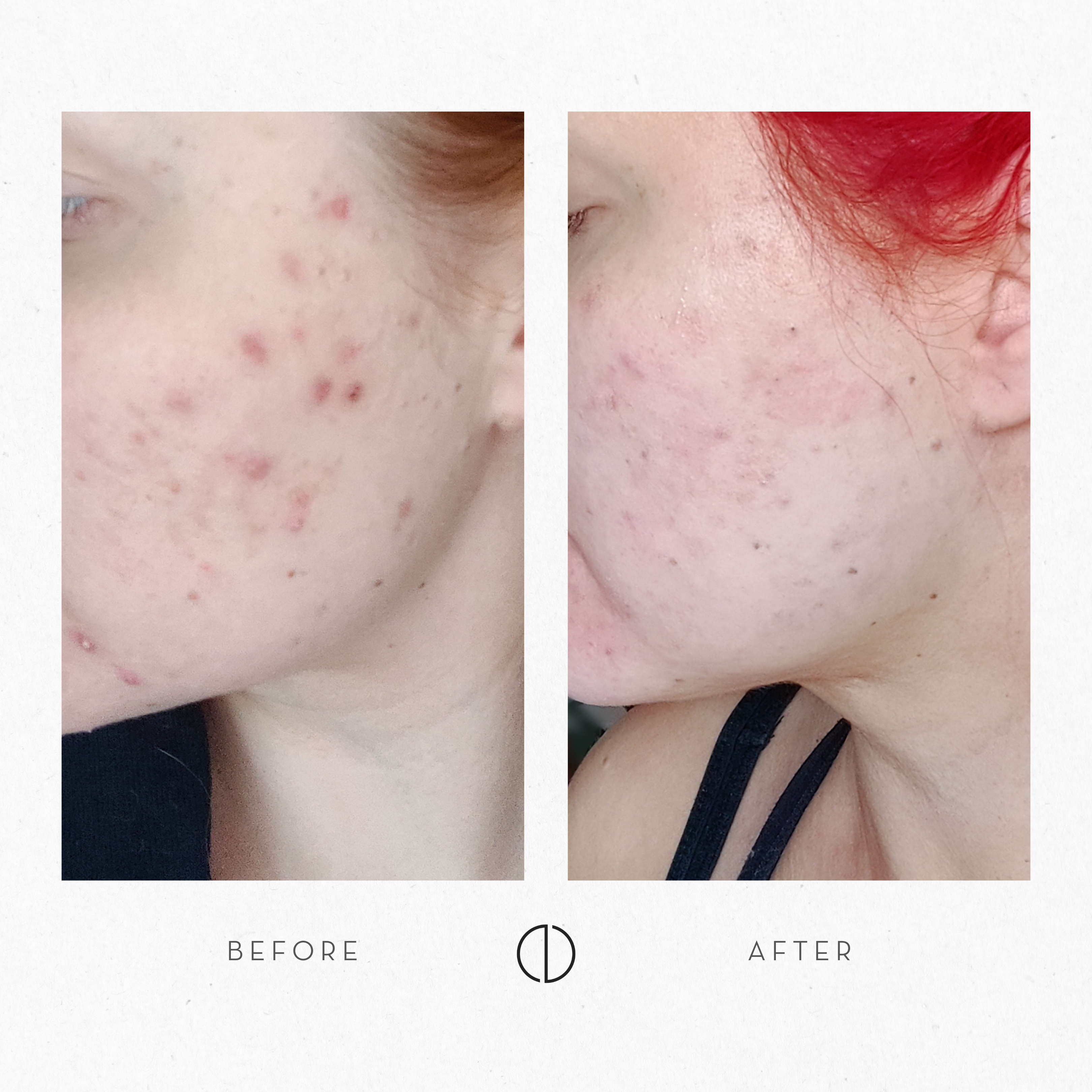 Iida-Maria: Dry skin & adult acne