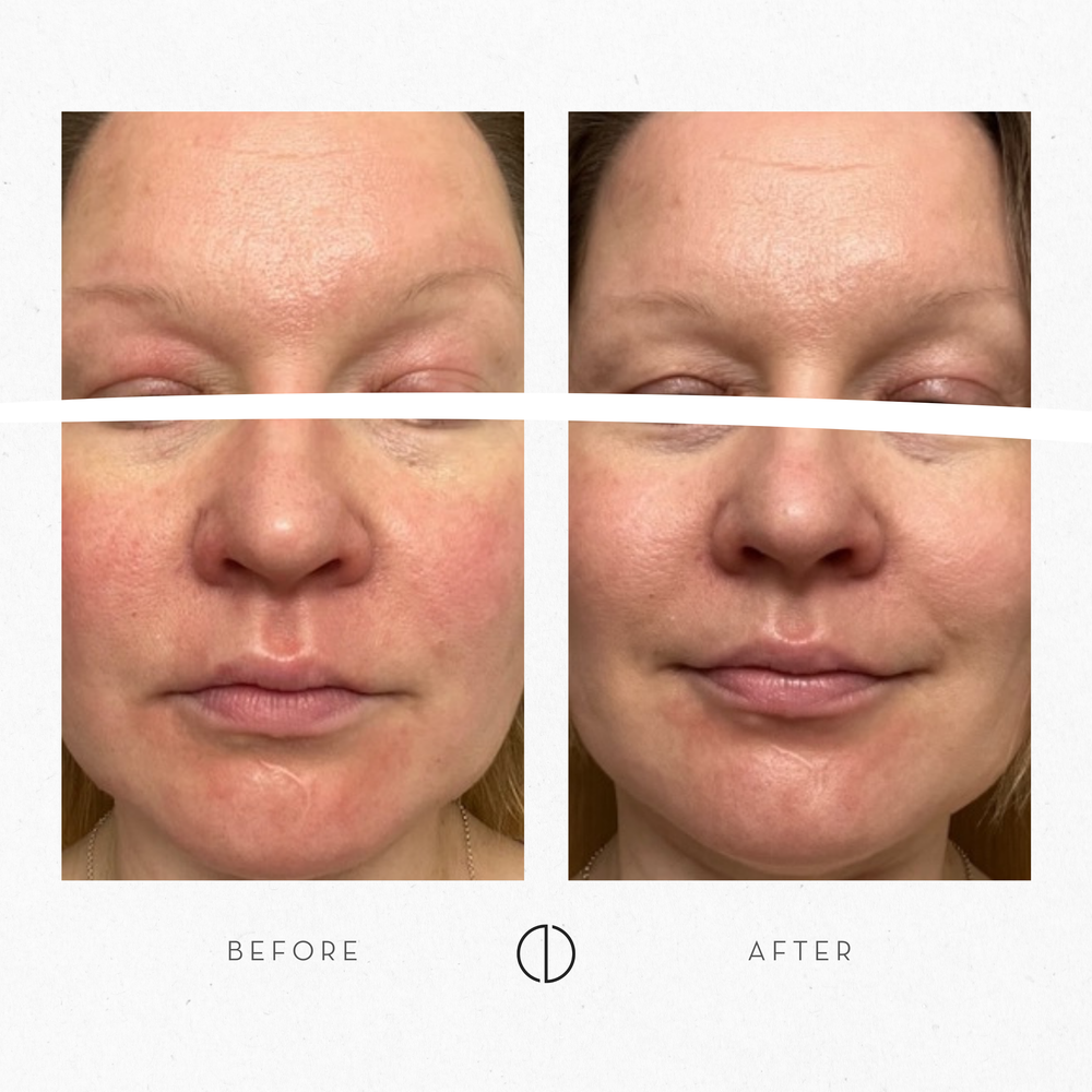 Marjut: Atopic skin