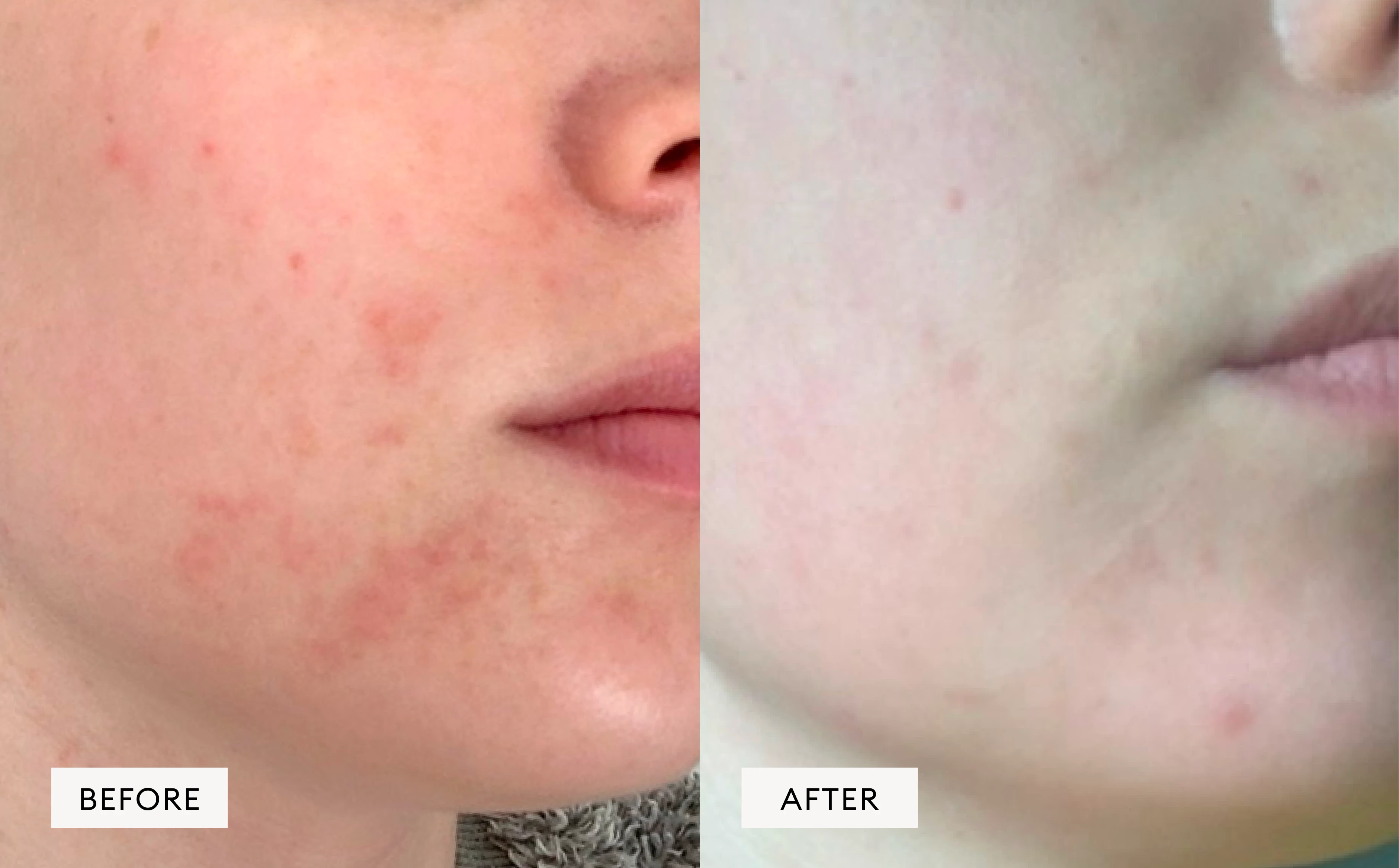 Reactive Redness Laponie Skincare I Irritated skin & Redness I Sensitive & Problem Skin