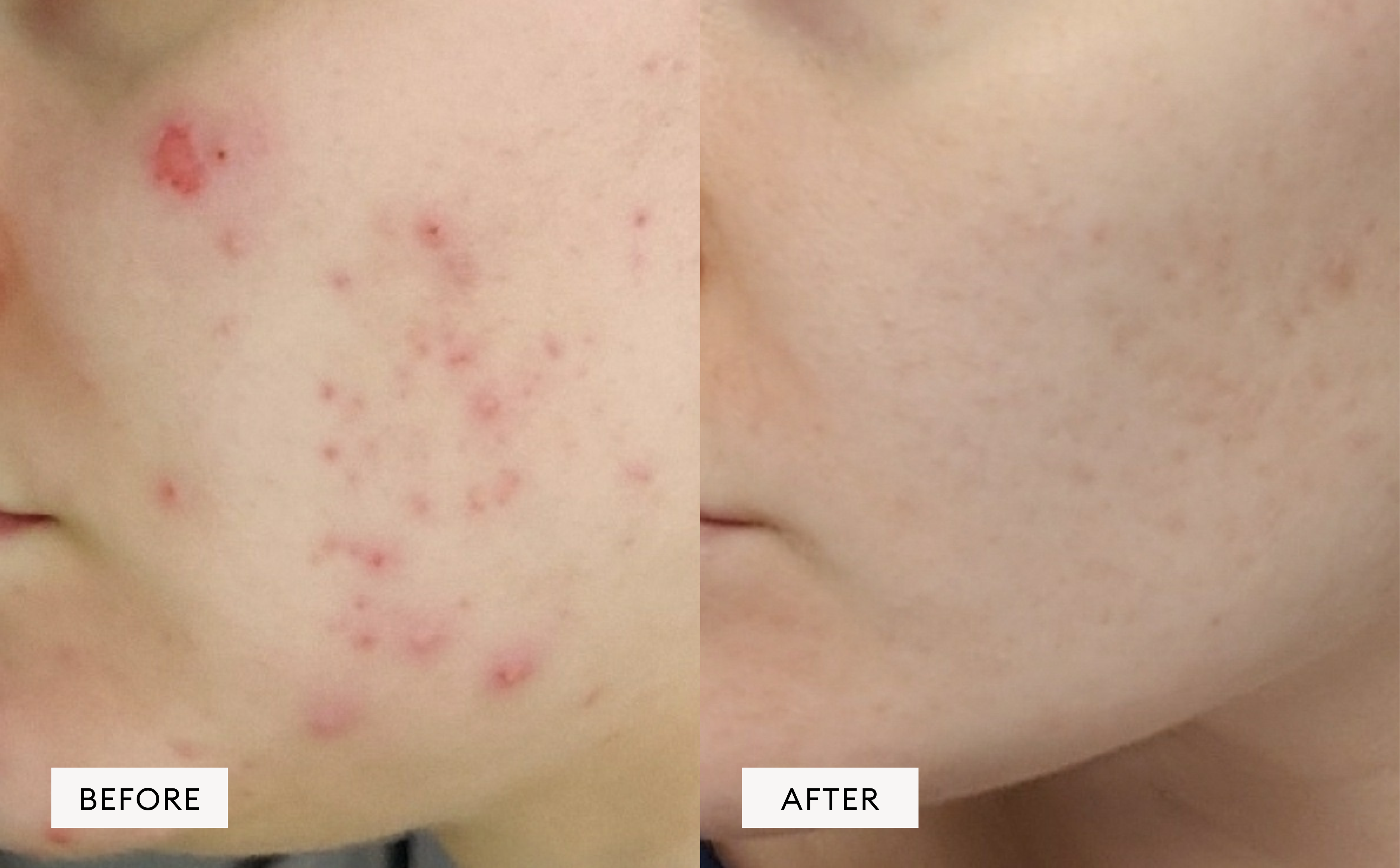 Acne & Impure skin