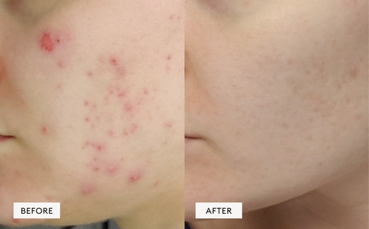 Acne & Impure skin